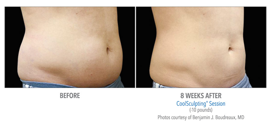 CoolSculpting Before After Images