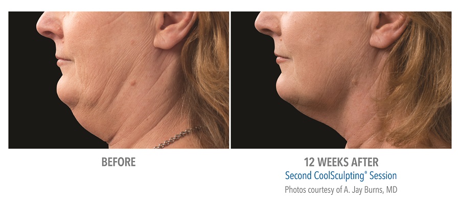 CoolSculpting Before After Images